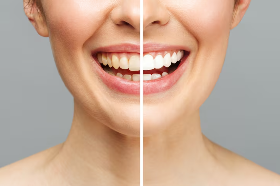 Professional teeth whitening treatment in Nagpur